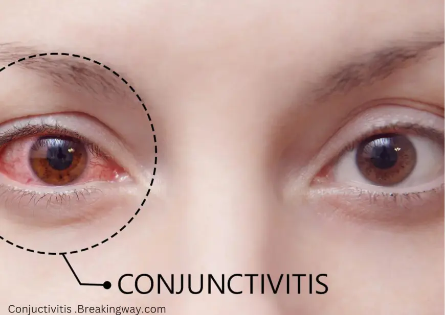 Everything You Need to Know About Conjunctivitis (Pink Eye)